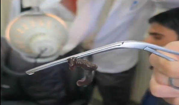 Large worm removed from nostrils of 12-year boy at GMC Anantnag