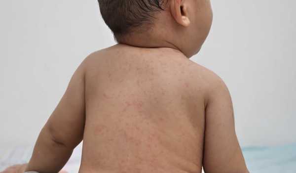 U.S. reports over 300 measles cases