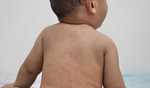 U S  reports over 300 measles cases